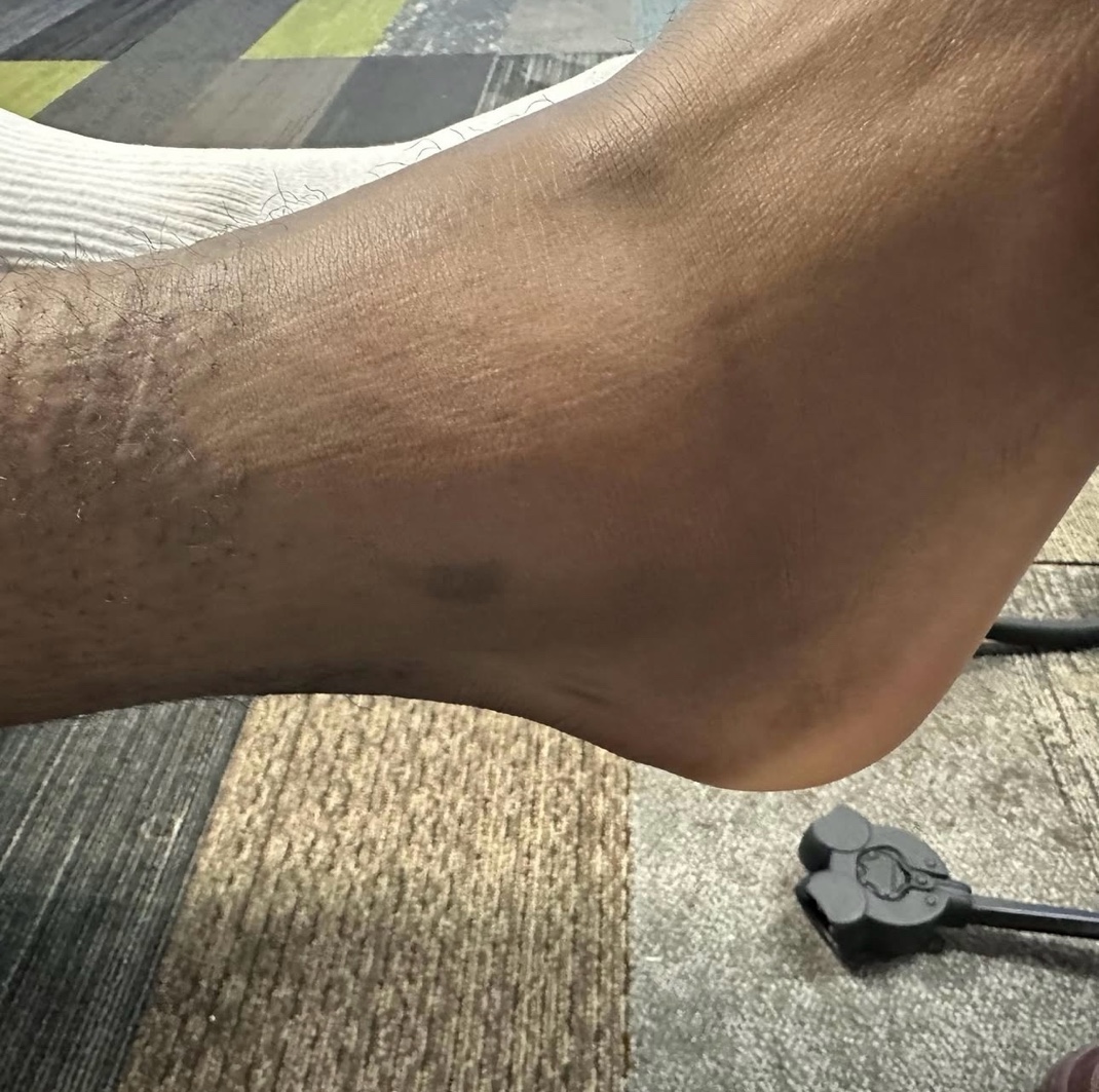 Ankle sprain after same-day multi-modality recovery treatment