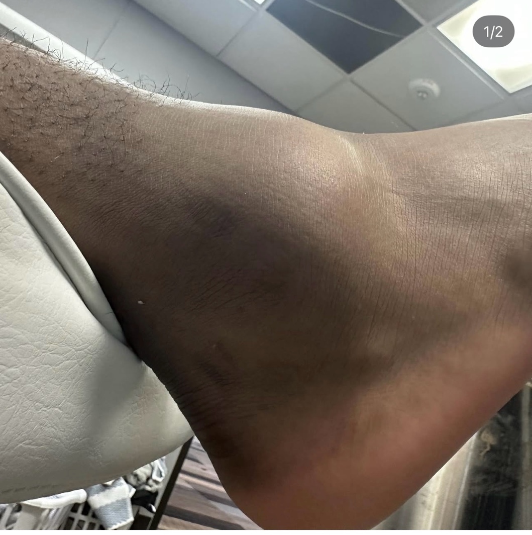 Severe ankle sprain before AIR recovery protocol