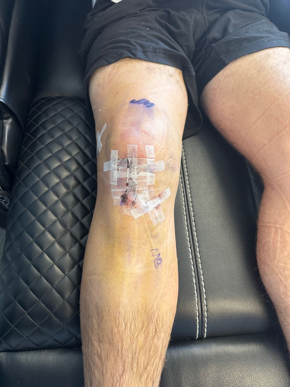 Post-ACL surgery knee after same-day multi-modality treatment